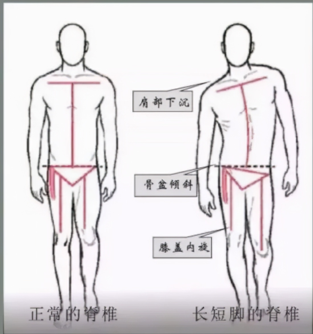 您所关心的正是我们关注的---儿童青少年脊柱侧弯(图2)